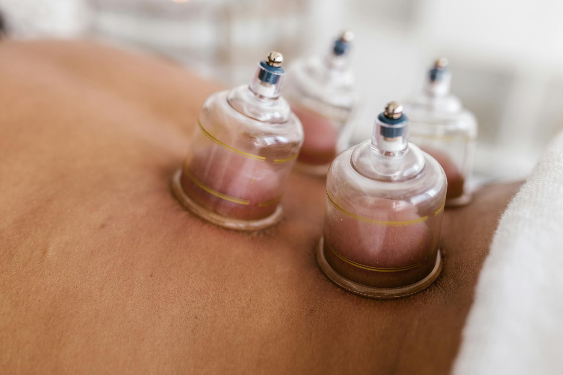 Cupping therapy (ventouses) : bienfaits, technique et indications