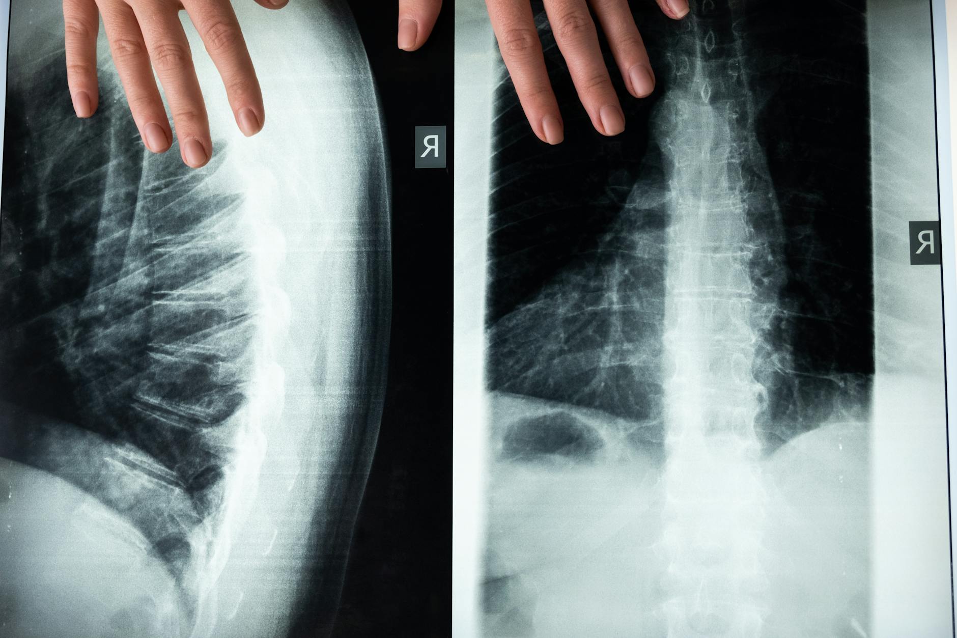 Un implant intelligent sans médicaments contre la douleur chronique : où en est la recherche ?